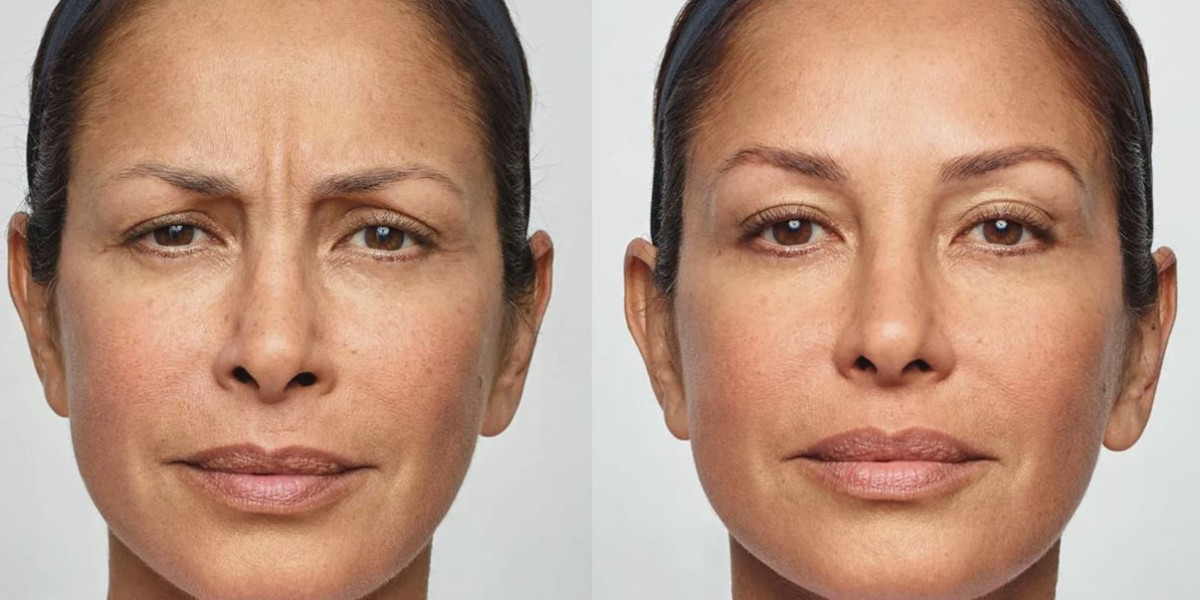 Nasenkorrektur Zürich: Experten Für Ihre Schönheitswünsche